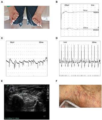 Mononeuritis multiplex following immune checkpoint inhibitors in malignant pleural mesothelioma